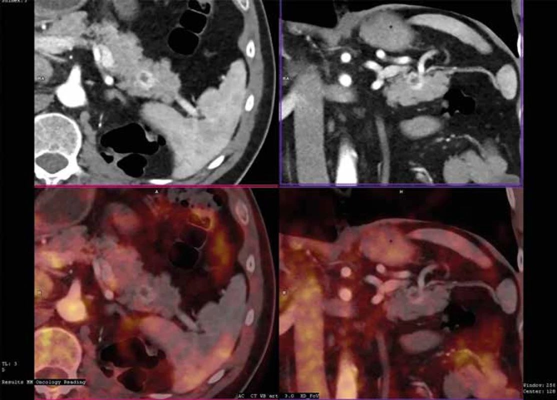 Metastáza světlobuněčného karcinomu ledviny do pankreatu v CT obraze<br>
Fig. 2: CT findings of clear cell renal carcinoma metastasis to the pancreas