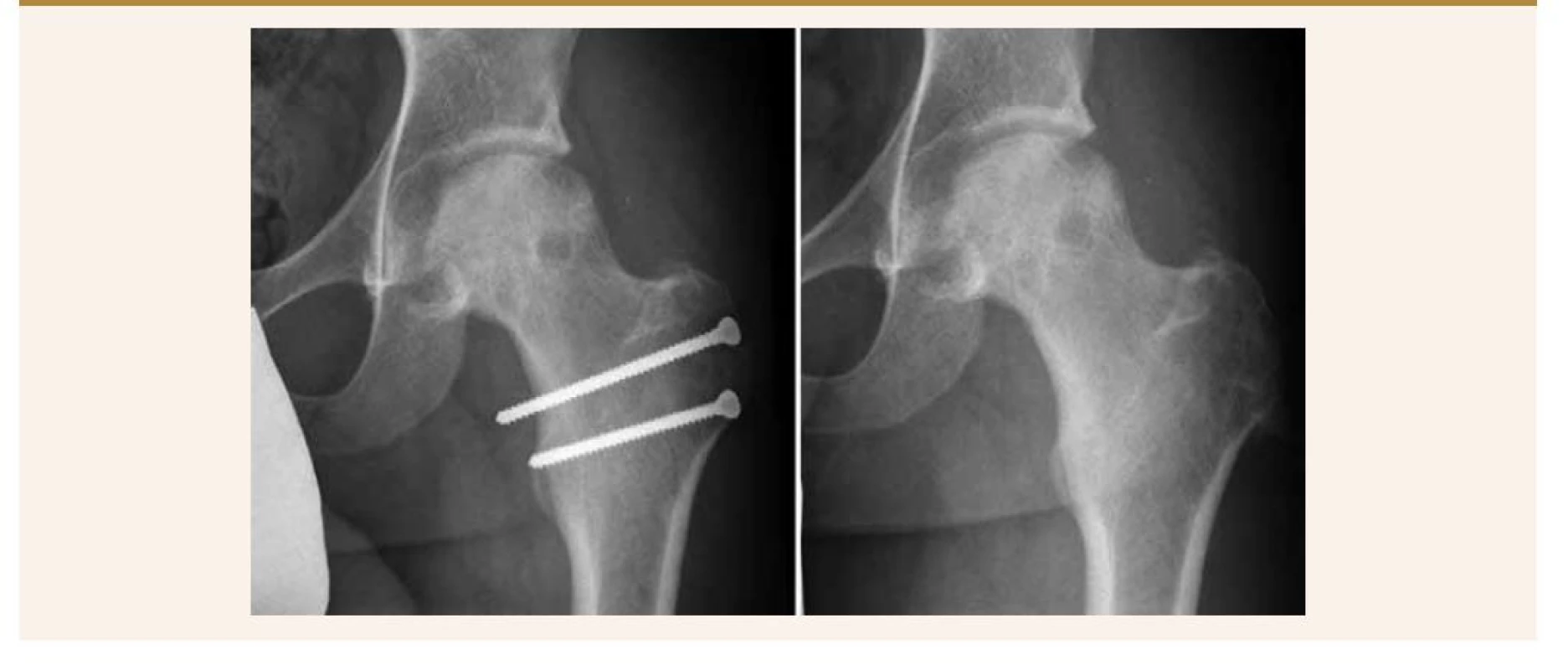 Vľavo: pacient pred extrakciou osteosyntetického materiálu. Vpravo: 12 mesiacov od operácie, po extrakcii
skrutiek.