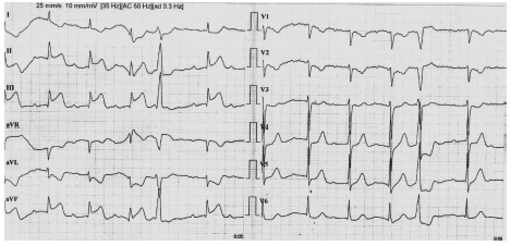 EKG křivka 1 při přijetí pacienta do nemocnice