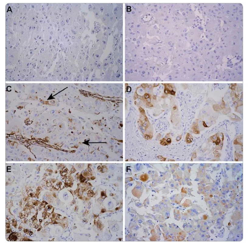 Immunohistochemical profi le of the tumor.
Tumor cells were negative for cytokeratins AE1/3 (A) and CD10 (B), focally positive for vimentin (C), and showed typical cytoplasmic positivity
for Melan A (D) and HMB45 (E). The cells showed also cytoplasmic MyoD1 (F) positivity reported in these tumors [15]. IHC-Px-DAB, 400×.