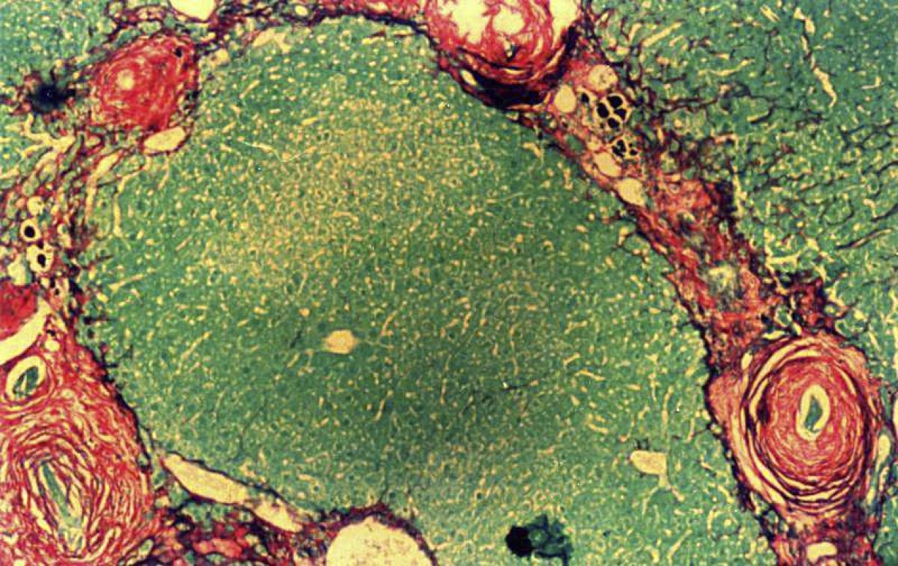 Perioválné granulomy kolem odumřelých vajíček
<i>Schistosoma mansoni</i>. Barveno <i>Picrosirius red</i>, jež barví
extracelulární matrix, zejména kolagen typu I a III, červeně,
živé buňky jaterního parenchymu zeleně.