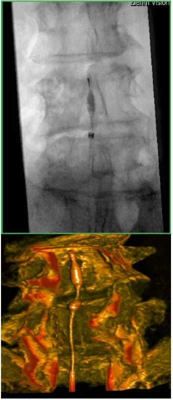 Skiaskopická (a) a CT (b) kontrola polohy epiduroskopu