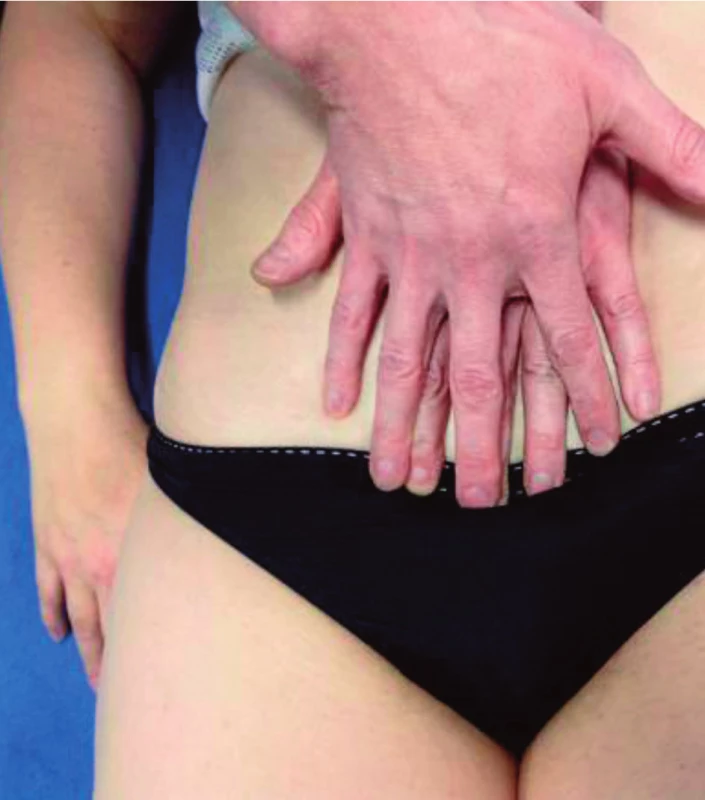 Pozice rukou při vyšetření a ošetření ligamenta
pubovesicale.