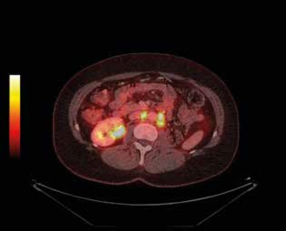 Pokročilý uroteliální karcinom pánvičky levé ledviny s lymfadenopatií – PET CT (restaging) <br>
Fig. 9: Advanced urothelial carcinoma of the renal pelvis of
the left kidney with lymphadenopathy – PET CT ( restaging)