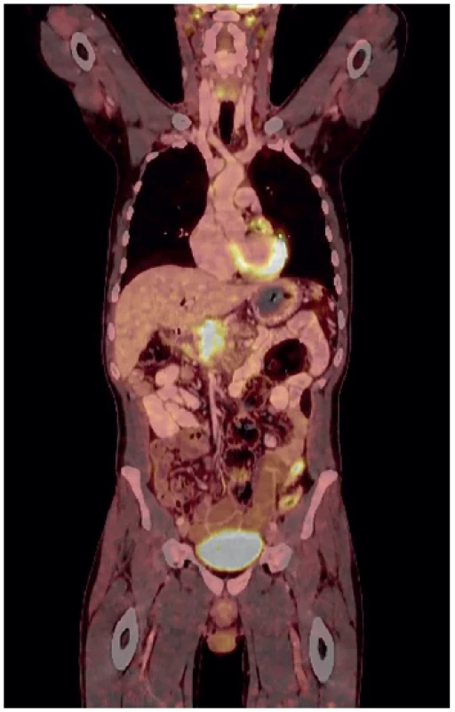 PETCT – progredující neodstranitelná masa hlavy
pankreatu <br> 
Fig. 6. PETCT – progression of an inoperable tumor in the
head of the pancreas