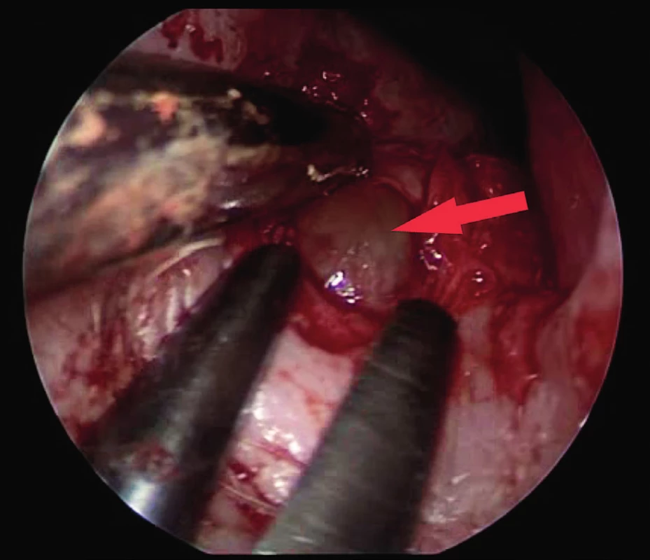Exstirpace cysty (šipka), endoskopický pohled, pravá
strana