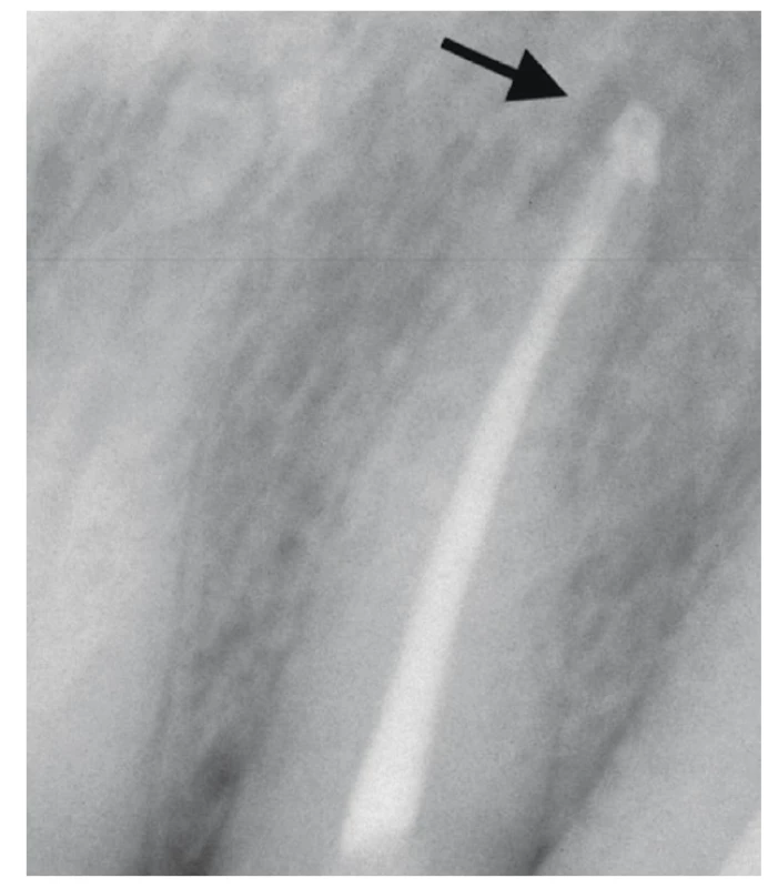 RTG snímek bezprostředně po zaplnění s extruzí materiálu do periodoncia <br>
Fig. 11 X-ray image immediately after root canal filling with extrusion of material into the apical periodontal area