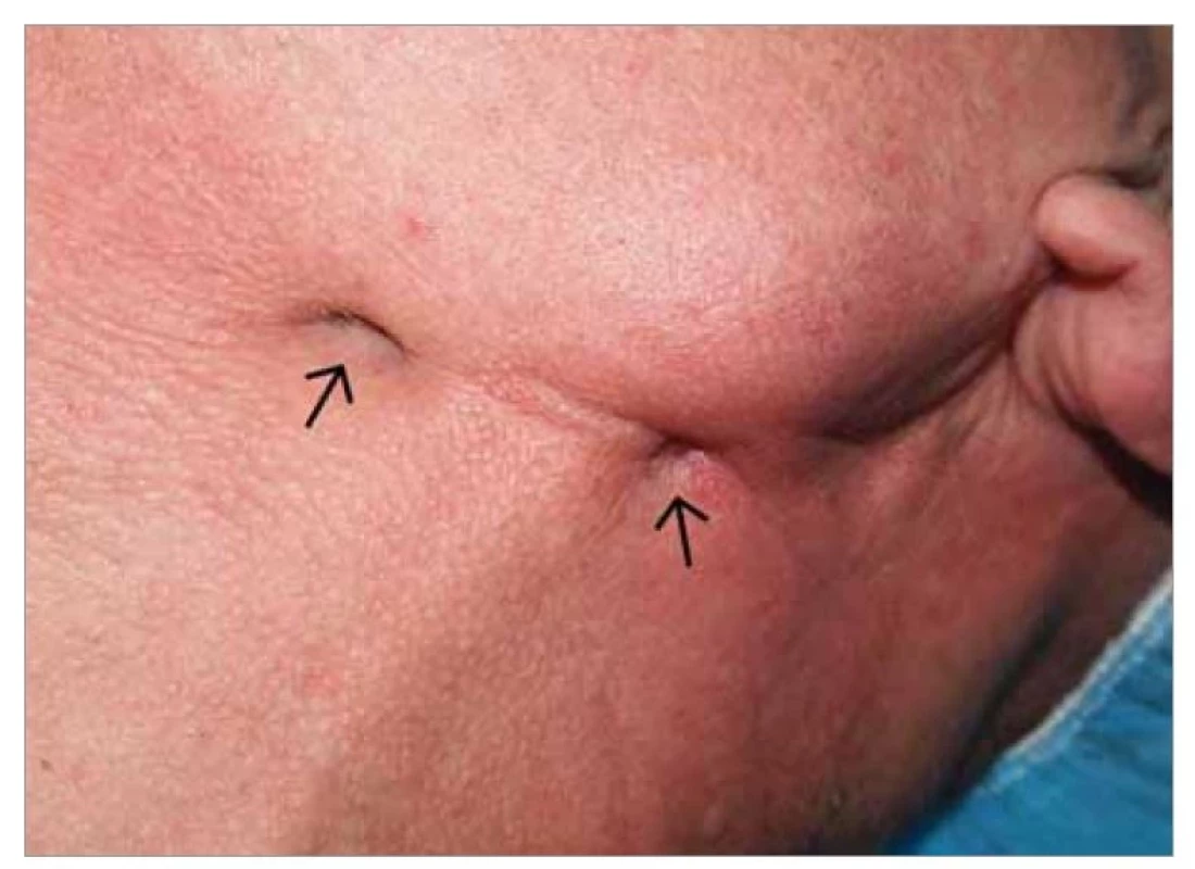 Submandibulární zduření se dvěma kožními píštělemi (šipky).<br>
Fig. 1. Submandibular swelling with two skin fistulas (arrows).