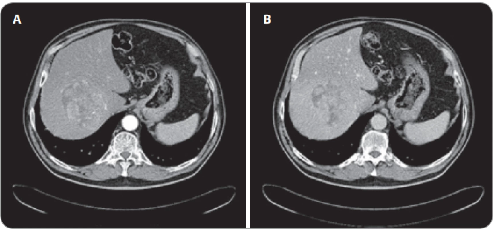 A, B. Vyšetření CT objemného heterogenního hepatocelulárního karcinomu v terénu steatofi brózy v pravém jaterním laloku s hypervaskularizací v arteriální fázi a s vymýváním v portální fázi. 