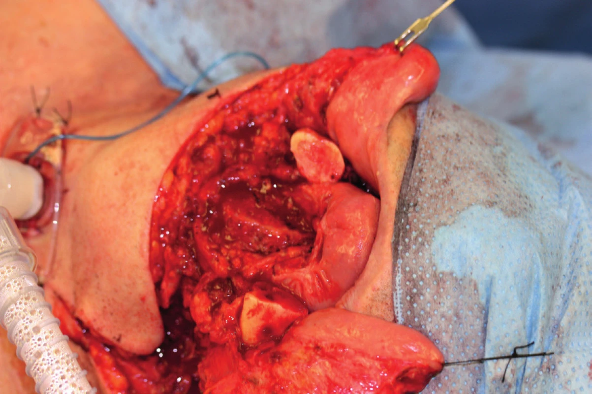 Defect after resection of the mandibula and the base of the oral cavity (author’s archive)