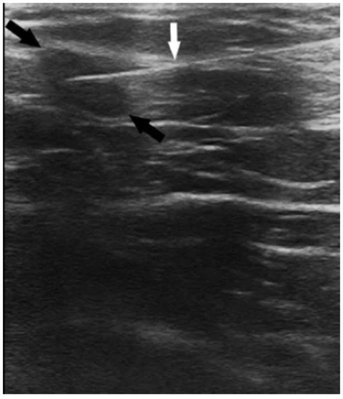 UZ obraz jehly (bílá šipka) zavedené do lymfatické
uzliny (černé šipky) <br> 
Fig. 1. Ultrasound image of needle (white arrow) inserted
into the lymph node (black arrows)