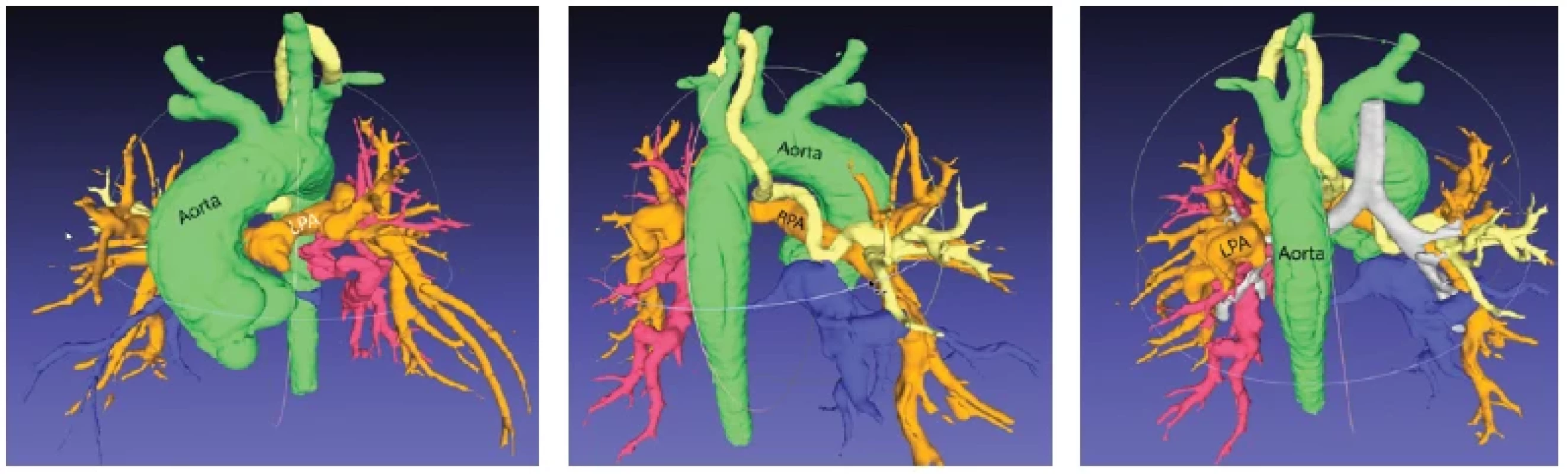 3D virtuálny „odliatkový“ model extrakardiálnych cievnych štruktúr u 8-mesačného pacienta s natívnou VCC: atrézia pľúcnice
s defektom komorového septa a mnohopočetnými aortopulmonálnymi kolaterálami (MAPCAs). Oranžové cievy predstavujú natívne ramená
pľúcnice s minimálnym atretickým kmeňom. Žltá, modrá a červená cieva predstavuje jednotlivé MAPCAs. Pohľadmi z rôznych perspektív je
možné hodnotiť: ich odstupy z aorty / priebehy / prítomnosť stenóz v ich priebehu / pľúcne segmenty, ktoré jednotlivé MAPCAs zásobujú /
či sa spájajú s natívnymi ramenami pľúcnice. Žltá kolaterála nekomunikuje s ramenami pľúcnice. Červená kolaterála komunikuje s natívnym
ramenom pľúcnice (LPA ). Modrá kolaterála má pri svojom odstupe výraznú stenózu. Na obrázku vpravo je šedou farbou vysegmentovaný aj
tracheobronchiálny strom. Takto je možné definovať, ktoré kolaterály prebiehajú pred / za / nad / pod bronchami, čo je dôležitá informácia
pre kardiochirurga z hľadiska plánovania unifokalizácie týchto kolaterál v rámci operácie. Na základe analýzy 3D modelu bola naplánovaná
kompletná chirurgická korekcia pozostávajúca z uzatvorenia defektu komorového septa, spojenia pravej komory s krátkym kmeňom pľúcnice,
ligácie červenej kolaterály a z pokusu o unifokalizáciu (odpojenie kolaterály z aorty a jej našitie na natívne rameno pľúcnice) žltej a modrej
kolaterály na RPA (pravé rameno pľúcnice). Obrázok vľavo: anteriórny pohľad. Stredný obrázok a obrázok vpravo: posteriórny pohľad.