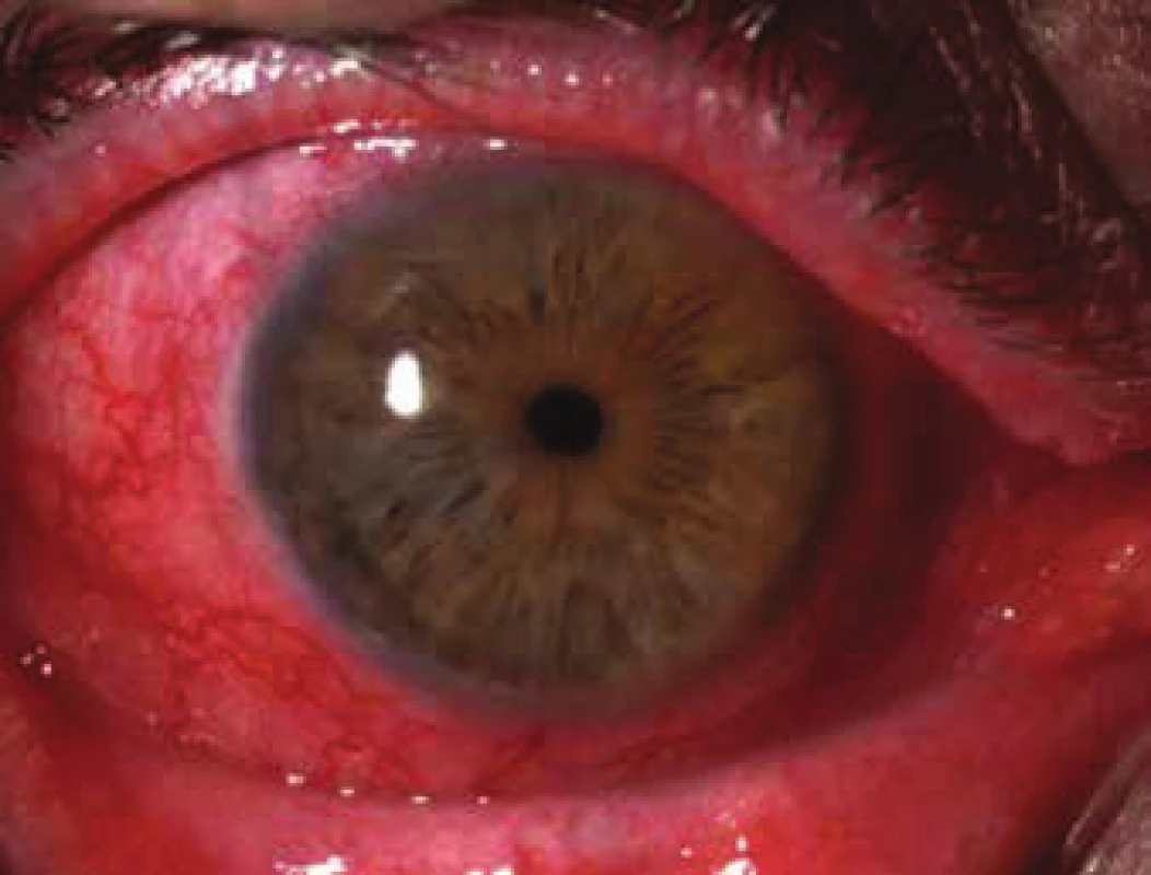 Diffuse scleritis with peripheral infiltration of cornea