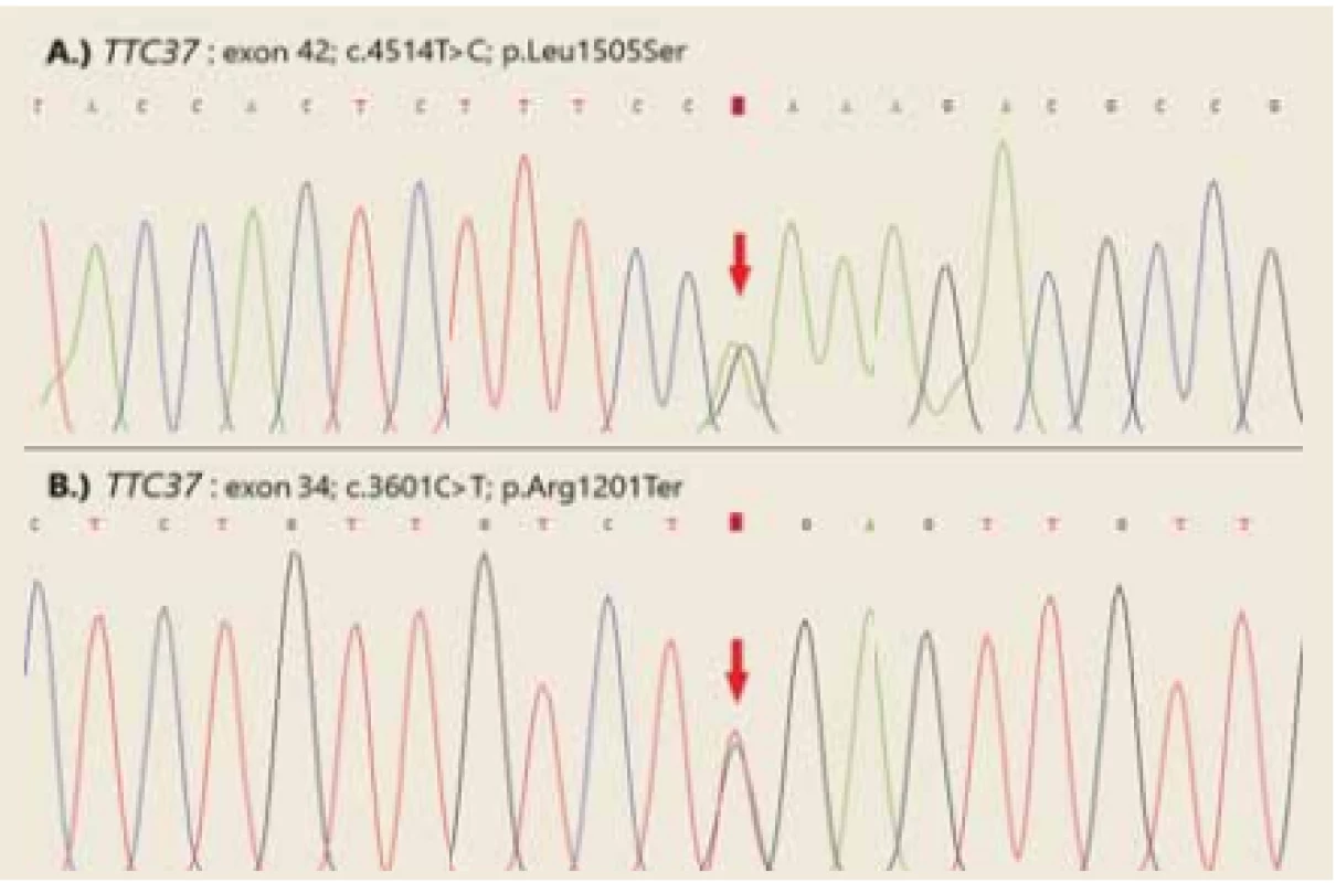 Confirmation of TTC37 variants by Sanger sequencing.<br>
Obr. 2. Potvrzení variant TTC37 metodou Sangerova sekvenování.