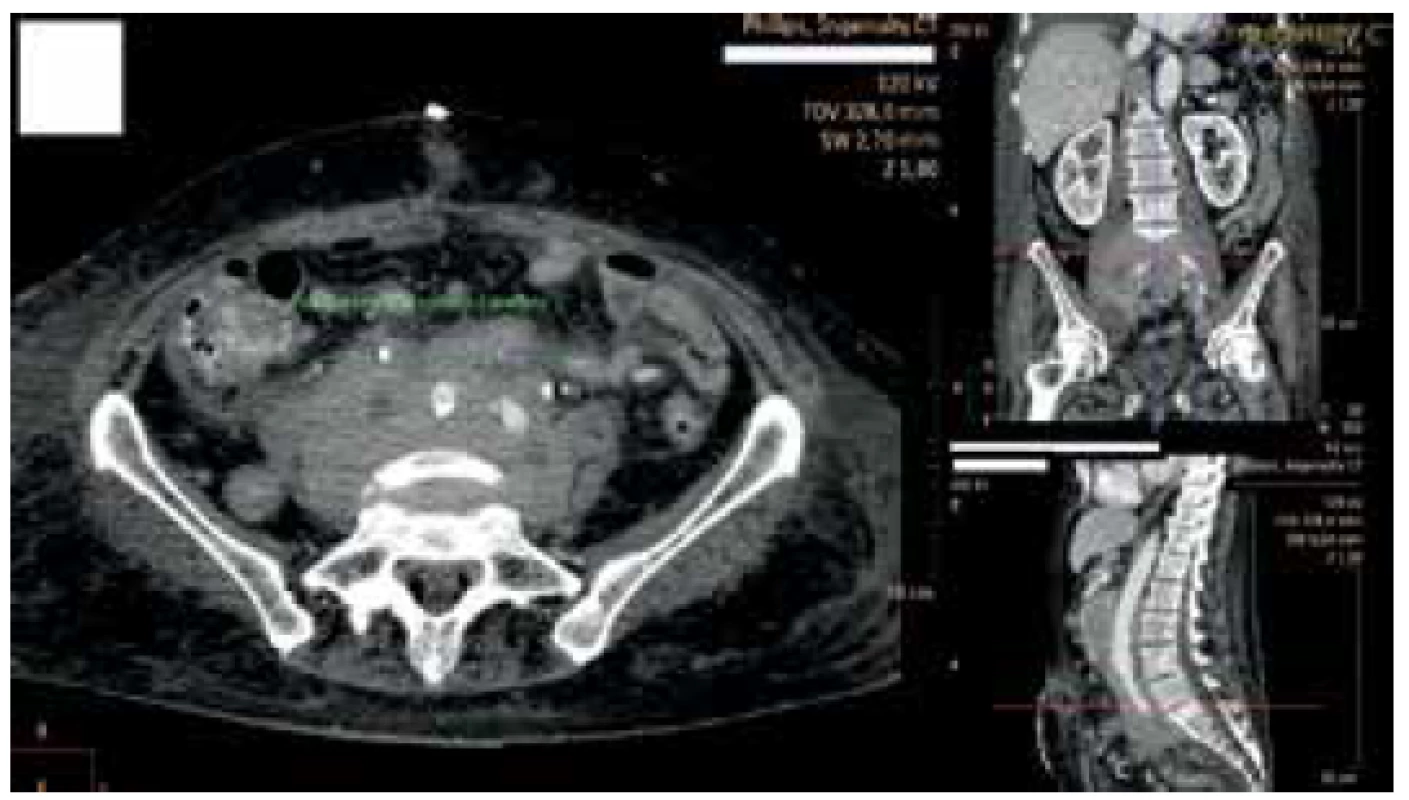Oblast výstupu stentu z ureteru<br>
Fig. 2. Double J stent exit point from the ureter