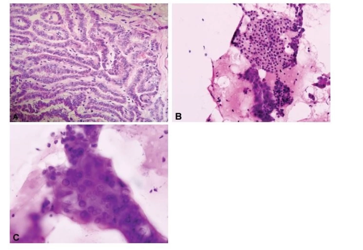 Porovnání peroperační „scrape“ cytologie a kryostatového
histologického řezu. (A) Ačkoli v některých případech mohou
být jaderné znaky papilárního karcinomu přítomny i v kryostatových
řezech (HE, 200x), (B, C) v peroperačních cytologických
preparátech získaných seškrabem tkáně z řezu nádorem jsou
obvykle výrazněji vyjádřena opticky prázdná jádra, jaderné pseudoinkluze
i jaderné zářezy (B, HE, 200x; C, HE, 400x).