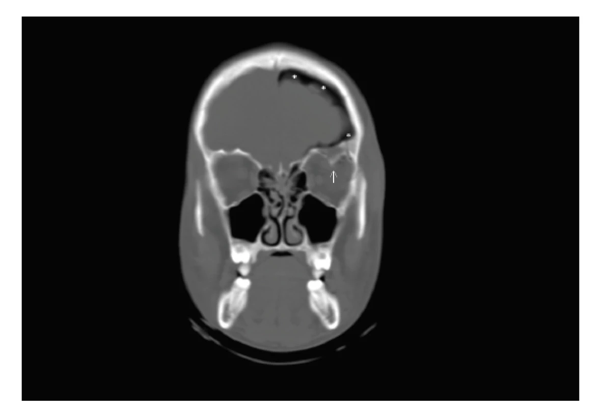 Blow-in fraktura stropu očnice s dislokovaným
úlomkem (bílá šipka), pneumocefalus (hvězdička), CT vyšetření,
koronární řez