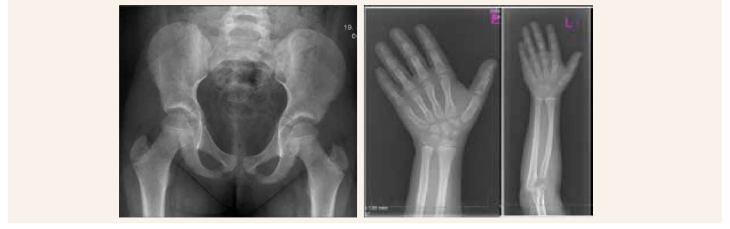 Skeletálny rádiograf naznačujúci zobákovité epifýzy rádia a širšie zápästné kostičky