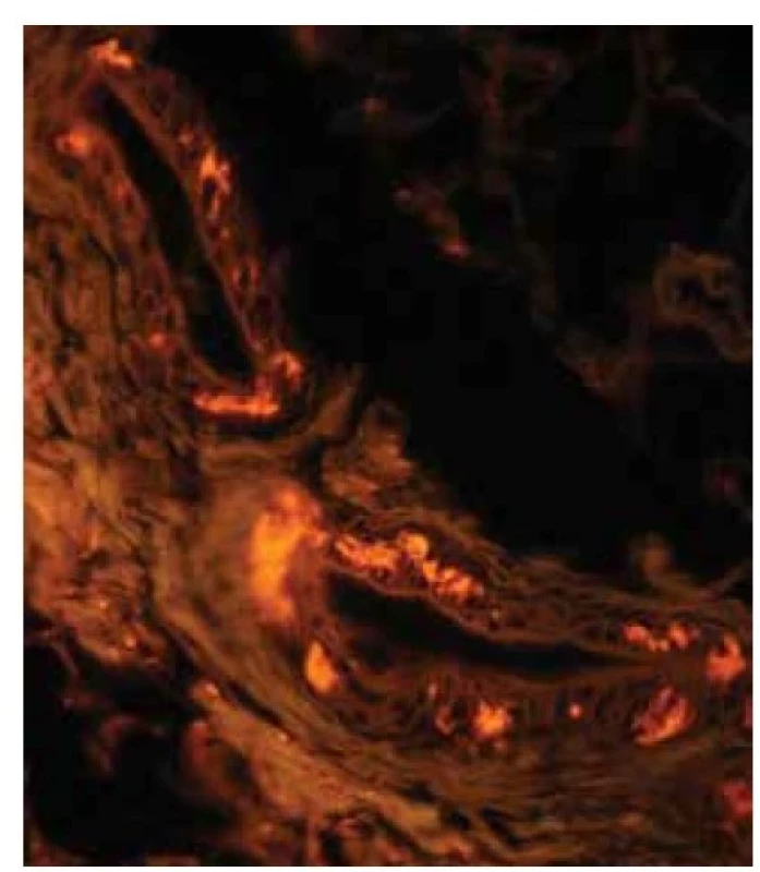 AL amyloidóza – fluorescenční mikroskopie<br>
Drobná depozita ve stěně krevních cév s červenou
fluorescencí. Původní zvětšení 600krát.