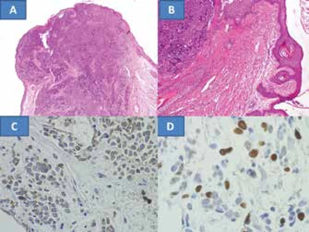 Extensive infiltration of eyelid with MCC with non-tumorous
tissue in edges, colouring HE – enlargement 100x (A) infiltration
with tumour in surrounding area of eyelash follicles, colouring HE
– enlargement 200x (B), neuroendocrine marker – chromogranin,
enlargement 400x (C), proliferation marker Ki67, enlargement
400x (D)
