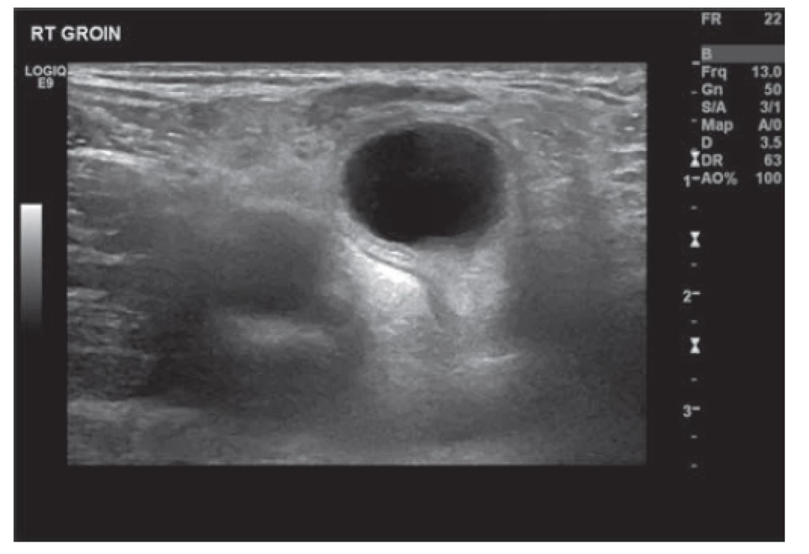 Ultrazvuk pravé kyčle zobrazující cystu<br>
Fig. 2: US right groin showing cyst