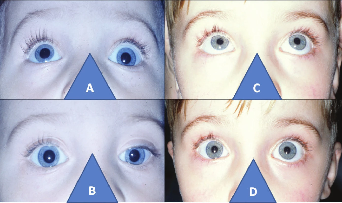 3-year-old boy with left-sided elevator palsy: elevation defect in left eye (A), with hypotropia on same side before cul-de-sac operation (B), and bilateral loose elevation (C), with parallel position of eyes two years after surgery (D)
