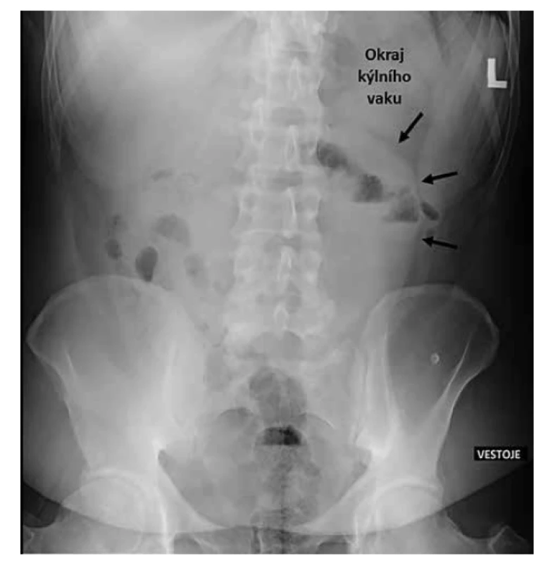 RTG snímek břicha<br>
Fig. 2: Abdominal X-ray