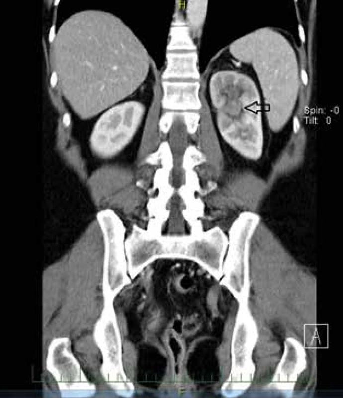 Pokročilý uroteliální karcinom pánvičky levé ledviny – CT <br>
Fig. 8: Advanced urothelial carcinoma of the renal pelvis
of the left kidney − CT