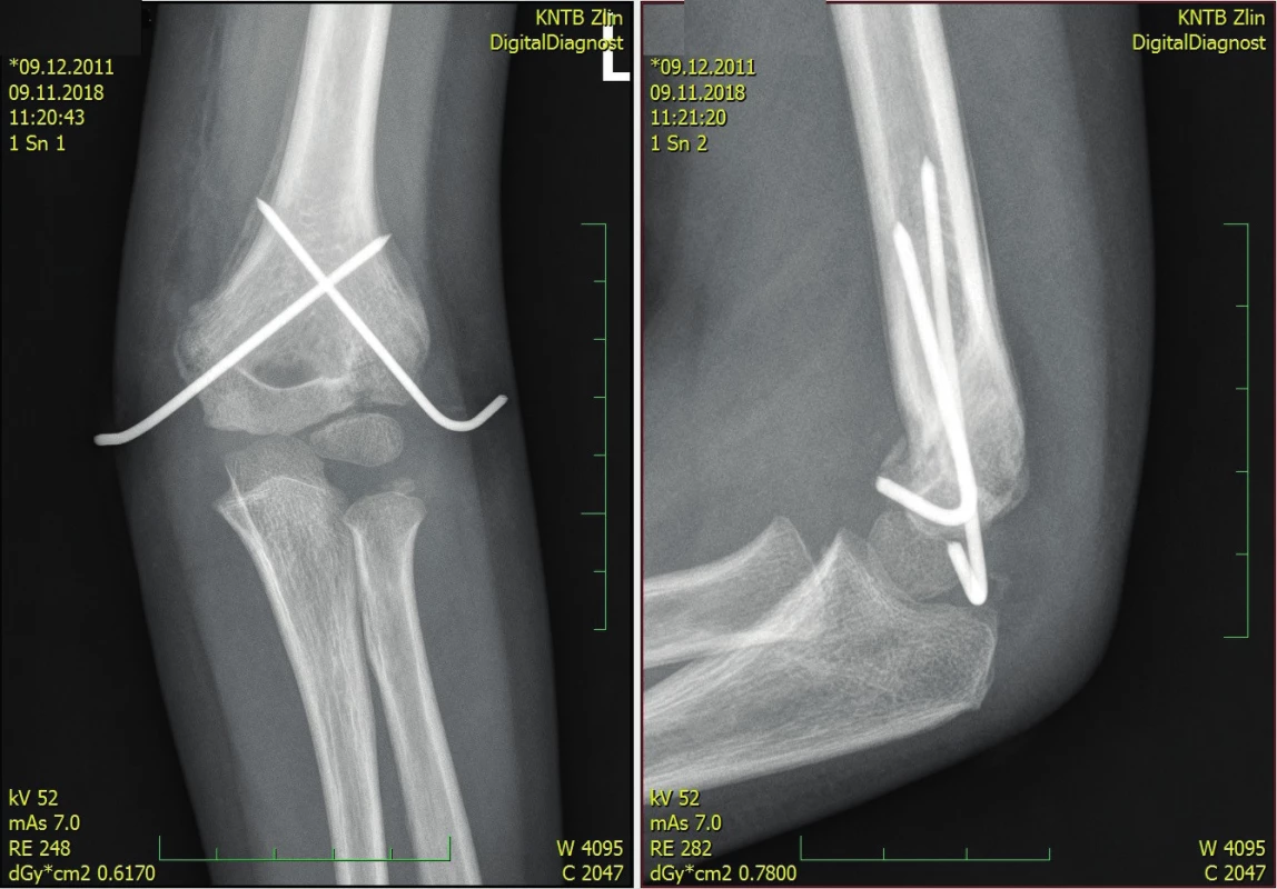 Suprakondylická zlomenina fixována ve správném postavení,
snímek ve třech týdnech