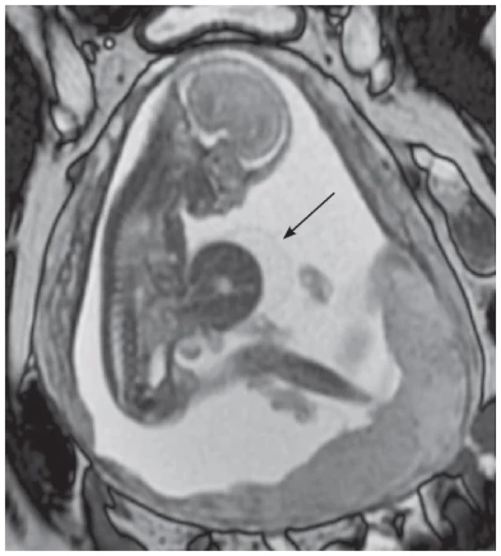 A 22-week-old fetus with a giant omphalocele. The sagittal
Single Shot Fast Spin Echo (SSFSE) image at the midline demonstrates
herniation of the liver (arrow) through the anterior abdominal
wall. A thin membrane can be clearly seen covering the herniated
liver, which is characteristic of an omphalocele.