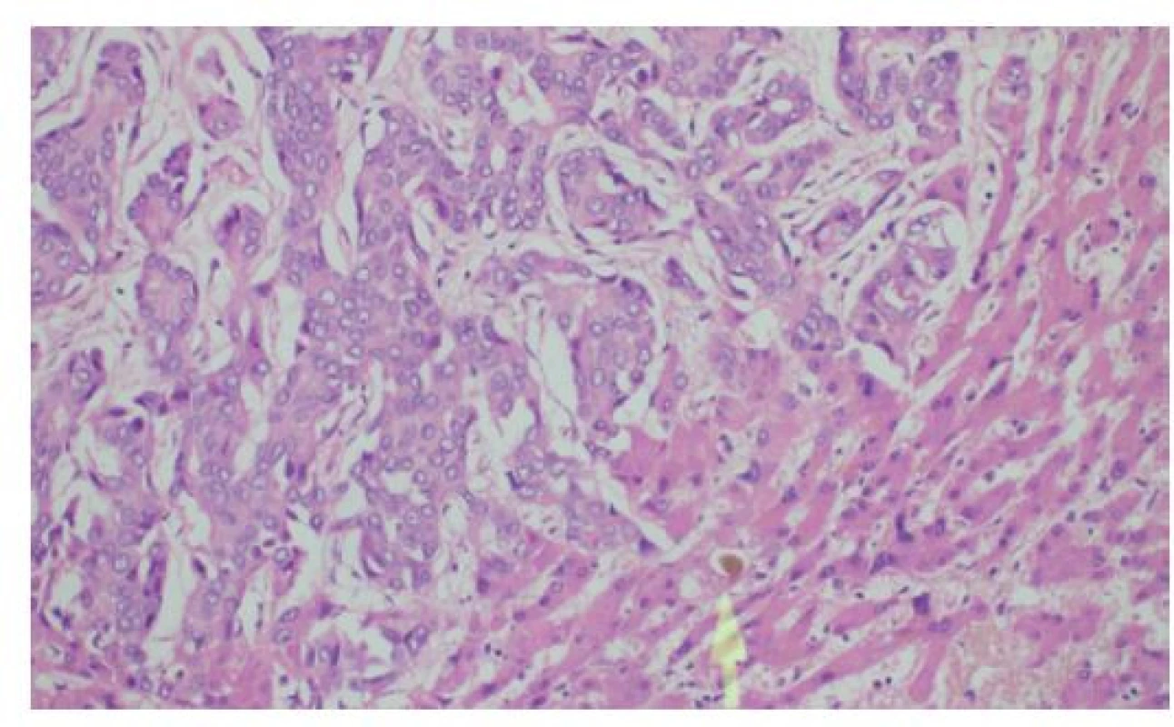 Histologie cholangiocelulárního adenokarcinomu
jater solidně-trabekulární stavby s anastomozujícími
trámci nádorových buněk, fokálně s rudimentárními žlázovými
luminy<br>
Šipka označuje žlučový trombus při akutní cholestáze v přilehlém
nenádorovém parenchymu jater, HE, 200×<br>
Fig. 4: Histology of liver cholangiocellular adenocarcinoma
characterized by solid trabecular-anastomosing
arrangement with occasional glandular lumina<br>
The arrow shows bile accumulation in adjacent liver parenchyma
due to acute cholestasis, HE, 200×