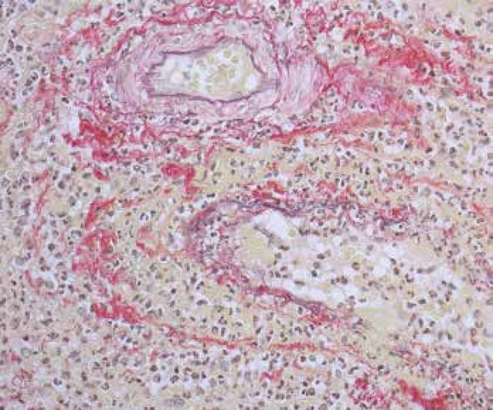 <b>Vaskulitida v biopsii z oblasti ORL. </b>Nahoře svalová arterie bez nekrózy a pod ní je na snímku vena se zánětlivou destrukcí stěny, fokálně s kompletní destrukcí elastiky (šipky) a s fibrinoidní nekrózou cévní stěny, fibrinoidní průsak je žlutý (barvení Srel).