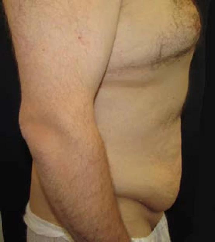 Lower body lifting – pohled z boku předoperačně