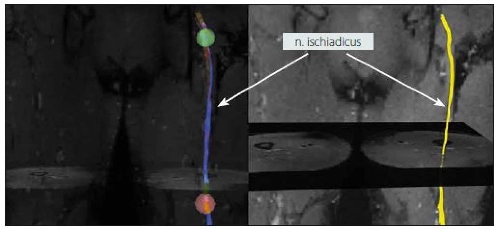 MR traktografie nervus ischiadicus vpravo v oblasti stehna u zdravého dobrovolníka (muž, 32 let).<br> Fig. 1. MR tractography of the right sciatic nerve in the thigh area of a healthy volunteer (male, 32 years).