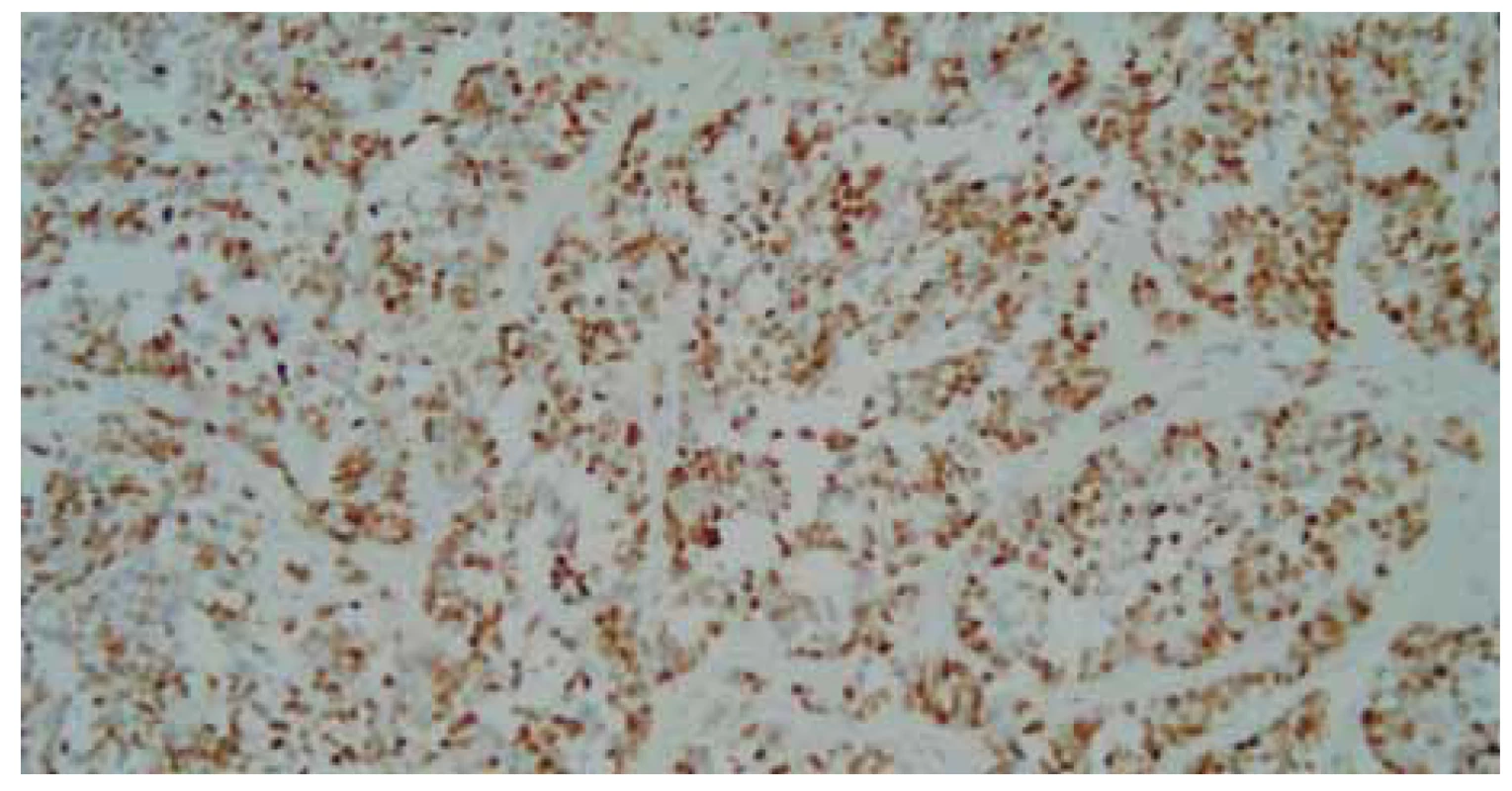 Detailnejší pohľad na malobunkovú nádorovú proliferáciu, farbenie hematoxylin-
eozinom, zväčšenie 200×.<br>
Fig. 8. A more detailed view of small cell tumour proliferation, hematoxylin eosin
staining, magnifi cation 200×.
