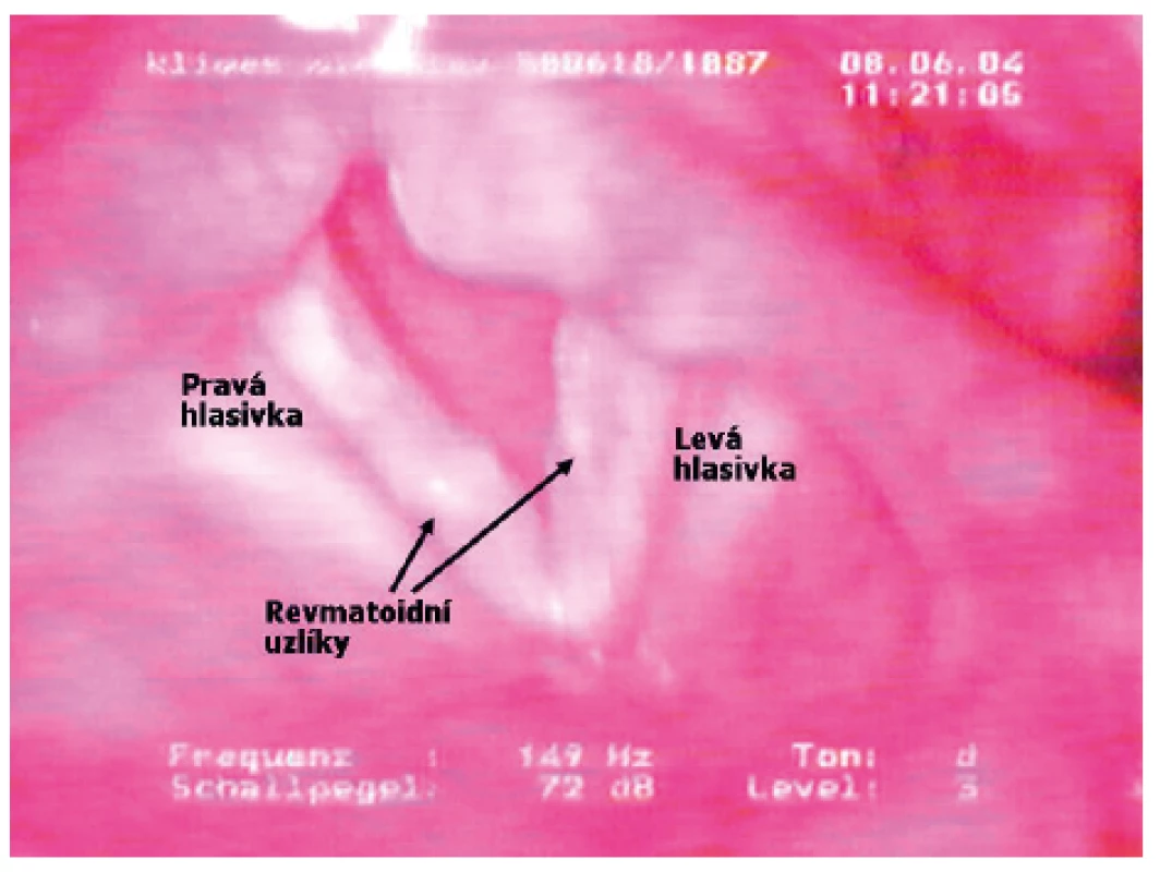 Laryngoskopický obraz revmatoidní nodulózy hlasivek
s histologickou konfirmací u 47letého muže s RA stupeň III (LFT:
1: 5120, aCCP2: 3800 U/ml), revmatoidní uzel nad levým loktem,
5 let MTX 10 mg týdně (Archiv ORL kliniky LF UK a FN Hradec
Králové s laskavostí MUDr. M. Hudíkové)