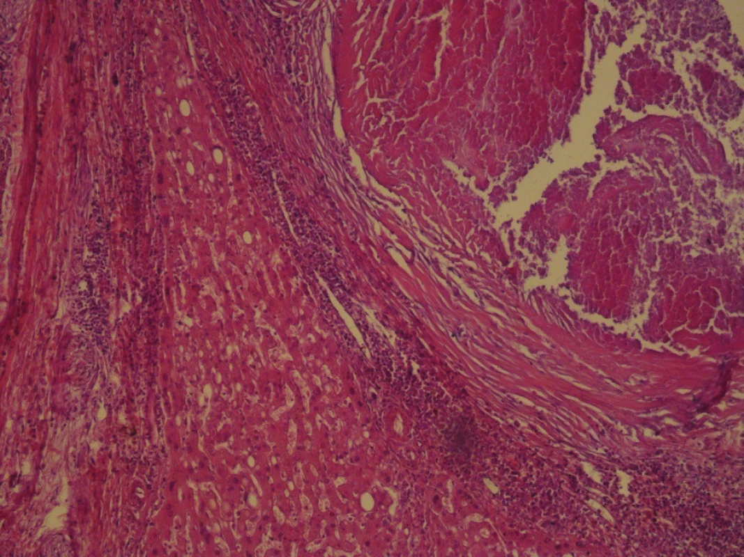 Histopatologické vyšetrenie
Na obrázku vidno parenchým pečene a časť pomerne dobre
ohraničeného ložiska s centrálnou kazeóznou nekrózou. Na
periférii nekrózy je epiteloidný lem s výraznejšou lymfocytárnou
reakciou (zväčšenie 20x, farbenie hematoxylínom a eozínom).<br>
Fig. 6: Hematoxylin Eozin stain
The picture shows the parenchymal liver and part of a relatively
well-defi ned bearing with central caseous necrosis. On
the periphery of necrosis, there is an epitheloid head with
more pronounced lymphocyte reaction (enlargement 20x).