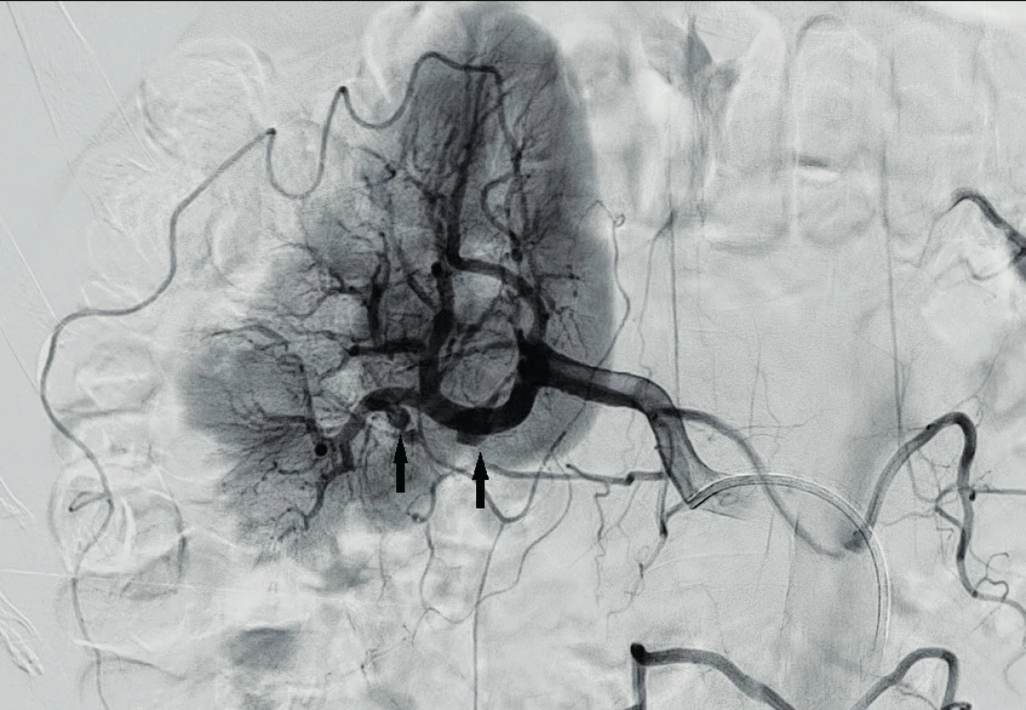 Selektivní angiografie pravé renální tepny potvrzuje
přítomnost několika aneurysmat (šipky). Rovněž je patrný
kompletní výpadek perfuze kaudální třetiny ledviny.