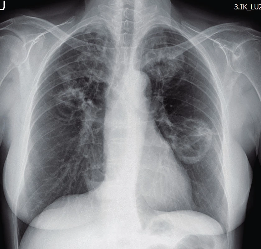 Rentgenový snímek plic u granulomatózy s polyangiitidou
s nálezem solidních kavitovaných lézí v obou plicních polích
(Radiologická klinika FN, Olomouc)
