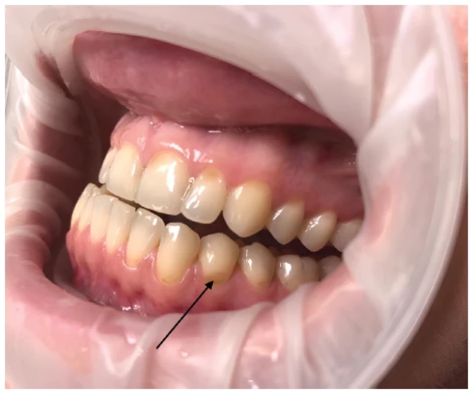 Zubní eroze (označené
černou šipkou) <br> 
Fig. 4
Dental erosion (black arrow)