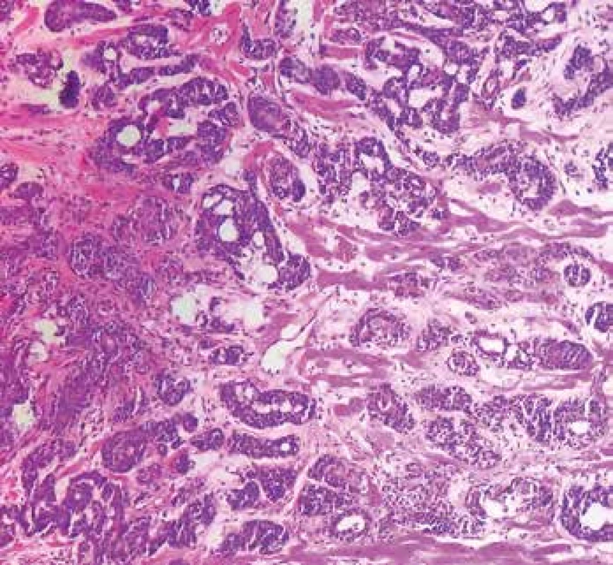 Metastatický adenoidně-cystický karcinom v myokardu (hematoxylin & eosin, 200x).