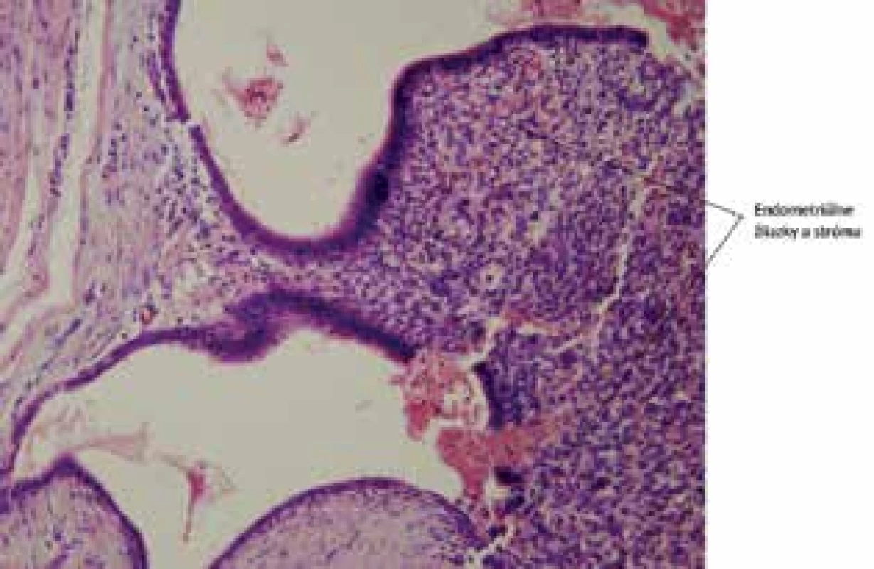 Endometrióza v  jazve: detailne zobrazené endometriálne žliazky. Farbenie Hematoxylín-eozín 100×<br>
Fig. 7: Abdominal wall endometriosis: detailed view of 
the endometrial glands, HE 100×