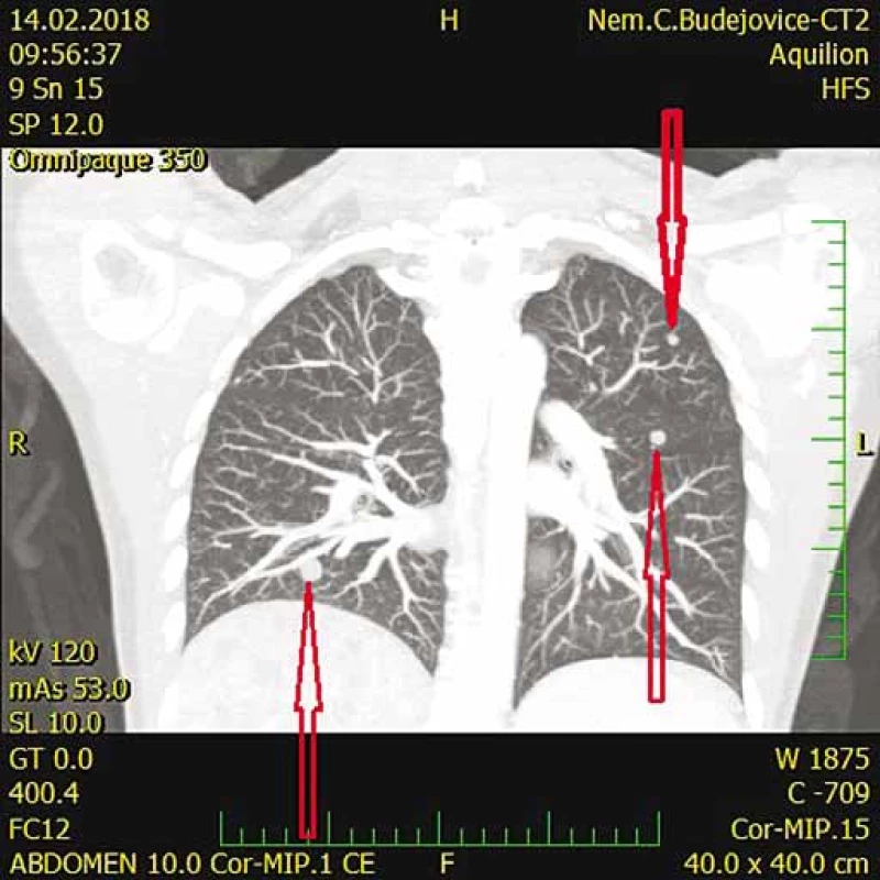 CT s nálezom pľúcnych metastáz (šípky).<br>
Fig. 3. CT scan shows lung metastases (arrows).