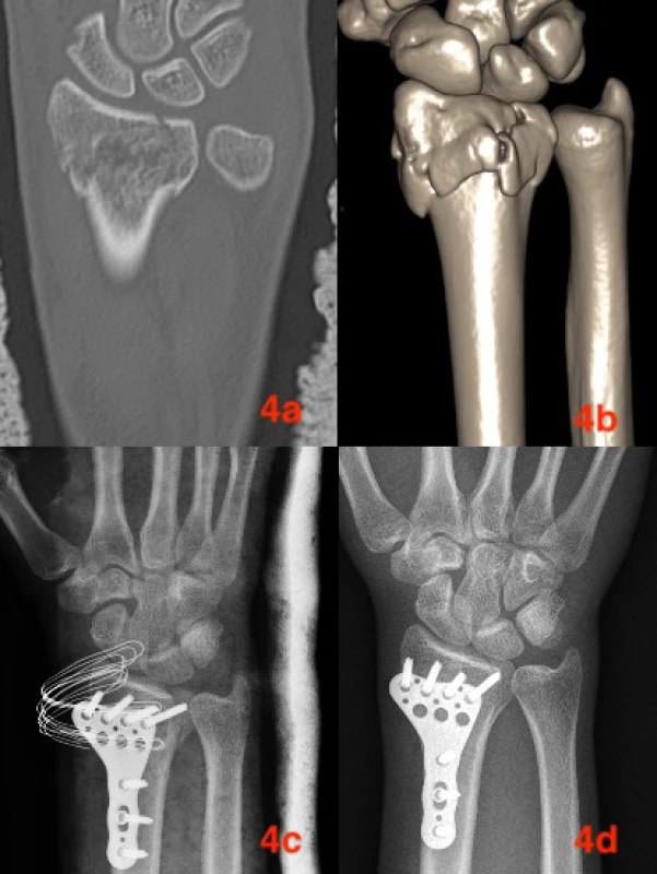 Pacientka 18 let − zlomenina 2R3C1
4a CT frontální řez, 4b CT 3D, 4c RTG kontrola do 48 hodin po
výkonu, 4d RTG kontrola 12 měsíců po výkonu.<br>
Fig. 4: Female patient, age 18 years − 2R3C1 fracture
4a CT coronal plane; 4b CT 3D; 4c X-ray examination within
48 hours postoperatively; 4d X-ray examination 12 month
postoperatively