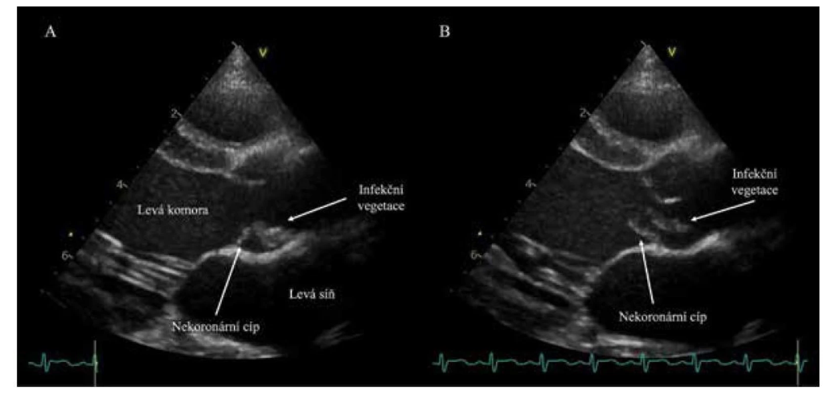 Echokardiografické vyšetření. Zobrazení aortální chlopně a infekční vegetace během srdečního cyklu.
A: Vlající vegetace na nekoronárním cípu v systole. B: Stejná struktura s prolabujícím nekoronárním cípem v diastole.<br>
Fig. 2. Echocardiography displaying aortic valve with a vegetation during a cardiac cycle. A: A vegetation attached
to the non-coronary cusp of aortic valve in systole. B: The same structure displayed in diastole.