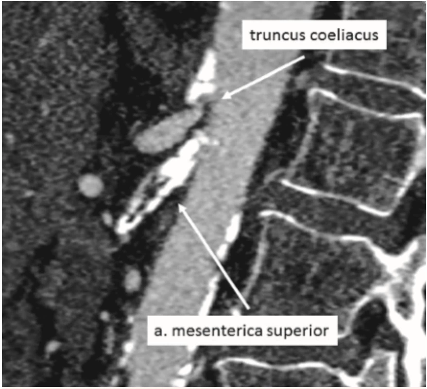Stenóza v odstupu truncus coeliacus i a. mesenterica superior v CT angiografickém zobrazení