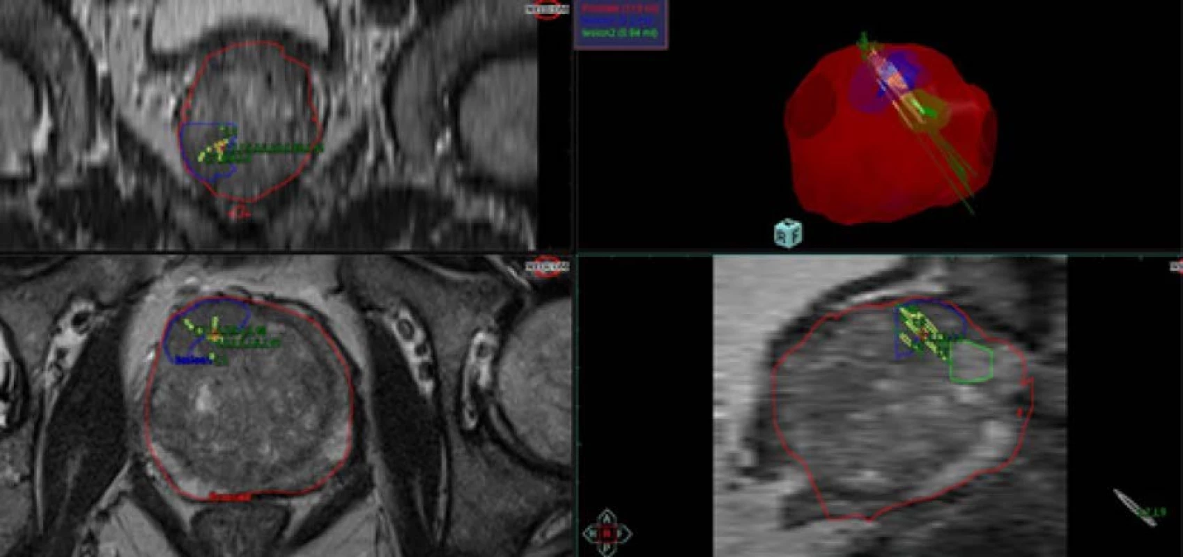 Report po softwarové fúzní biopsii prostaty<br>
Fig. 3. Report after software fusion – guided prostate biopsy