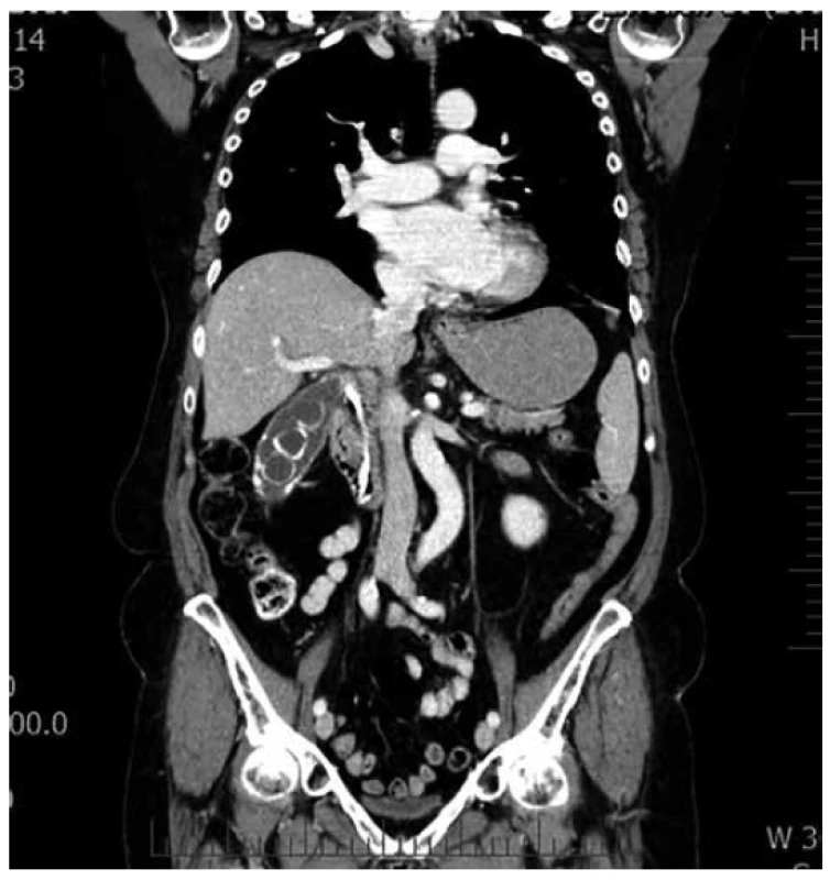 CT břicha<br>
Fig. 2. CT of the abdomen