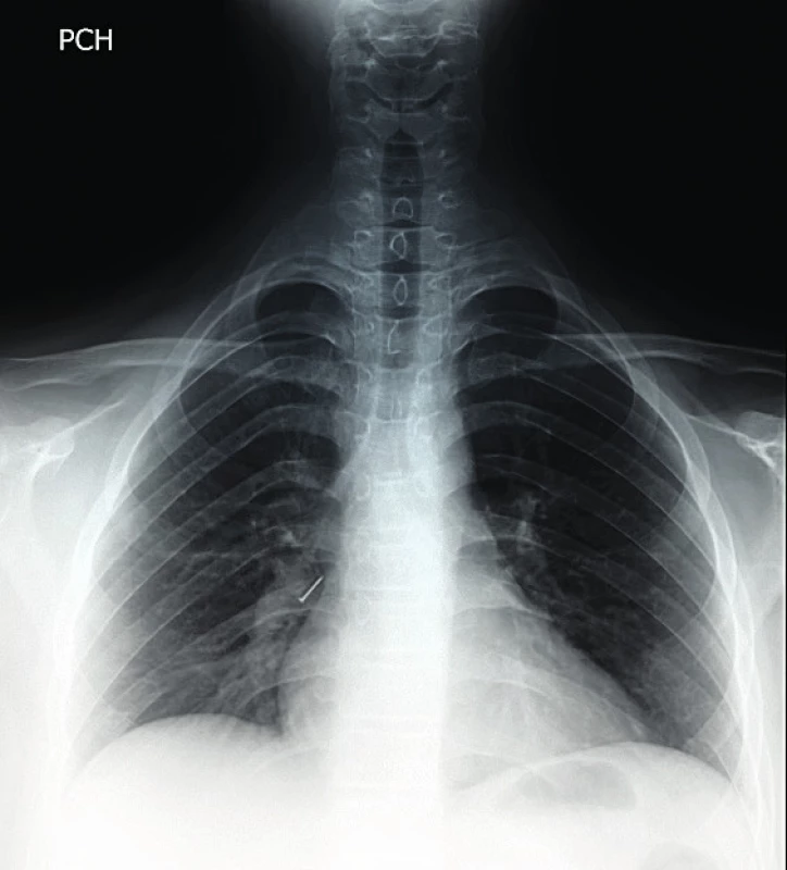   RTG snímka hrudníka s nálezom RTG kontrastného anorganického cudzieho telesa – špendlíka v predo-zadnej projekcii.<br> Fig. 1.  A chest X-ray with the finding of X-ray contrasting anorganic foreign body – a pin – anterior-posterior projection.