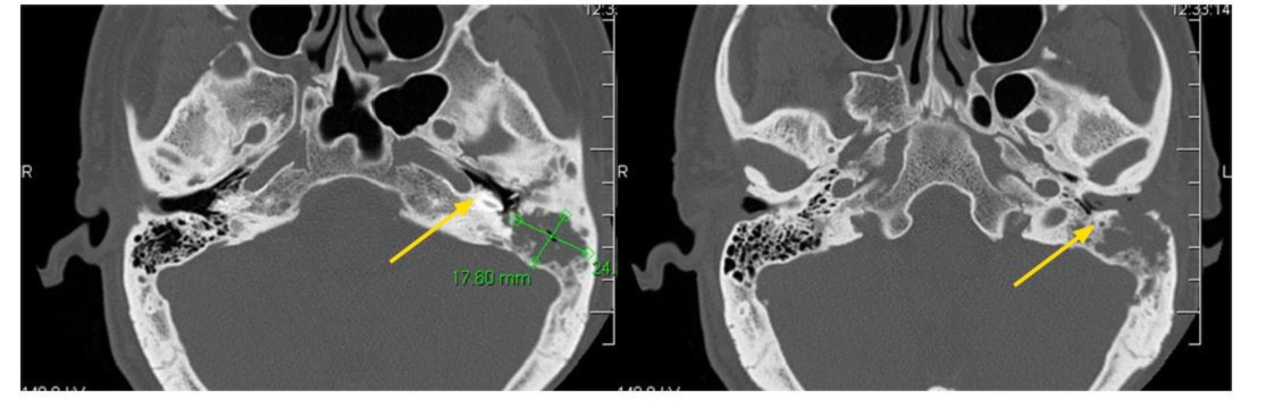 Histiocytóza z Langerhansových buněk (LCH) někdy postihuje zevní zvukovod. Způsobí zánět makroskopicky neodlišitelný od klasického zánětu
zevního zvukovodu. Pouze histologické vyšetření postižené kůže by mohla prokázat, že se jedná o LCH. Postupně infiltrace přestoupí na spánkovou kost
a vytvoří v ní osteolytická ložiska, jak dokumentuje tento CT obraz pacientky s pokročilým procesem ve spánkové kosti. Šipky ukazují místa destrukce
spánkové kosti